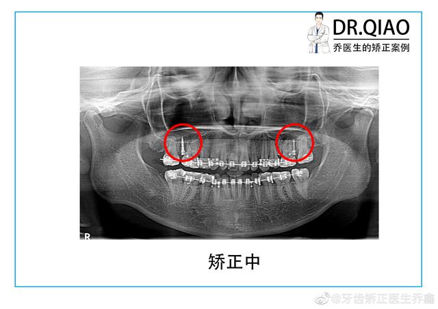 牙齿矫正中为什么要打骨钉？