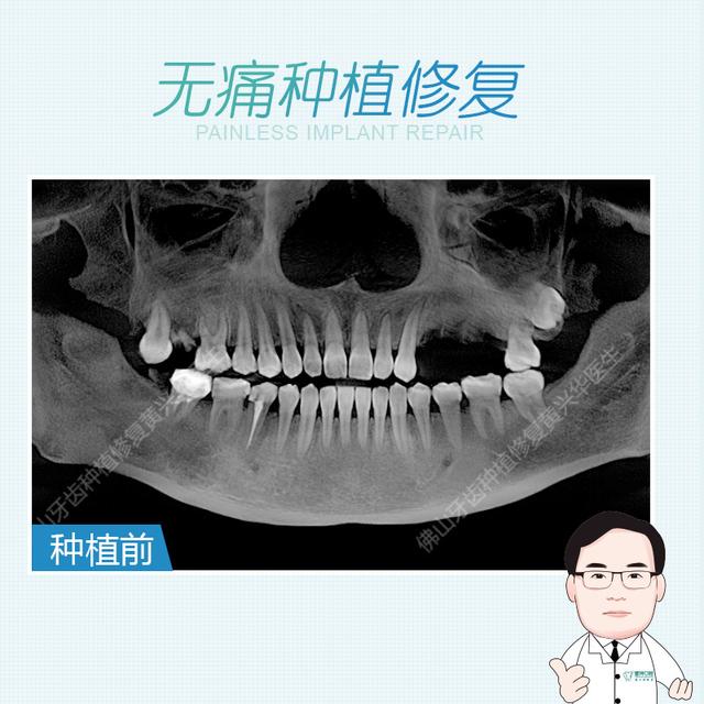 关于佛山种植牙最常见的问题解答（上篇）