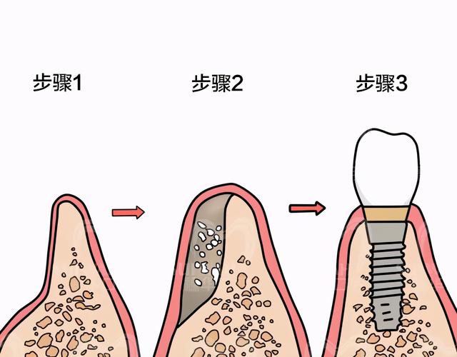 医生说骨头条件差，种牙加骨粉、骨膜，骨粉是什么东西吗？