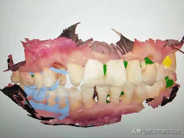 【关注口腔健康】数字化种植牙