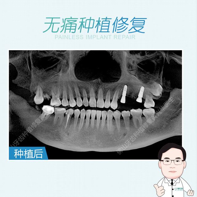 关于佛山种植牙最常见的问题解答（上篇）