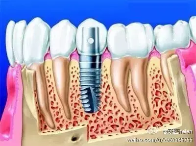 Helen齿科中心——烤瓷牙、种植牙能用多久？