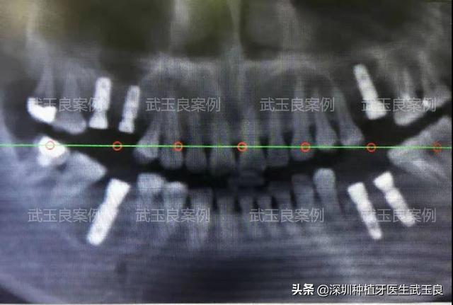 深圳种植牙：年度经典种植牙案例之牙齿龋坏，奥齿泰植体篇