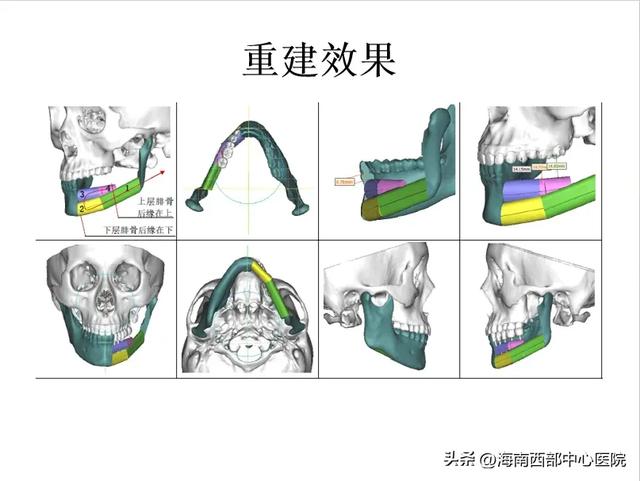 又一海南省首例！——海南西部中心医院口腔科顺利开展下颌骨肿瘤切除及腓骨皮瓣移植手术