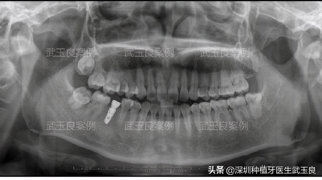 深圳种植牙：年度经典种植牙案例之牙齿龋坏，奥齿泰植体篇