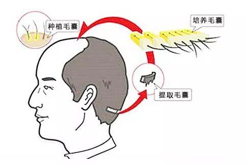 什么是头发种植术？种植之前做好功课，切不可粗心大意