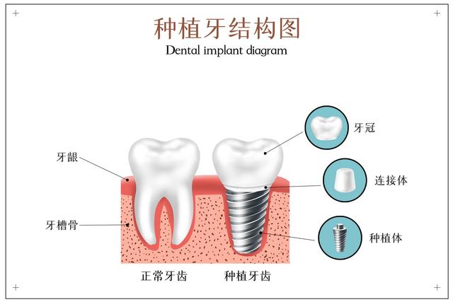 种牙后，出现哪些情况要及时到医院复查？