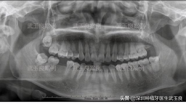 深圳种植牙：年度经典种植牙案例之牙齿龋坏，奥齿泰植体篇