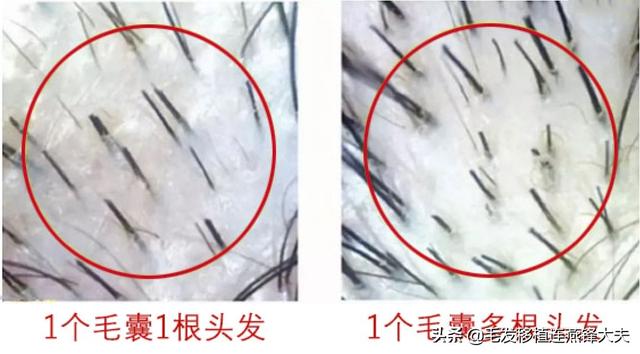 脱发面积相同 植发量及效果不同 这4点你可能还不知道！