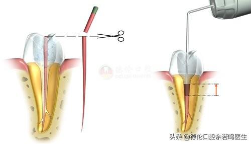 这里有2020牙齿修复方法大全及价格