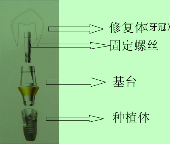 浅谈牙齿种植（2）