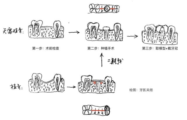 浅谈牙齿种植（2）