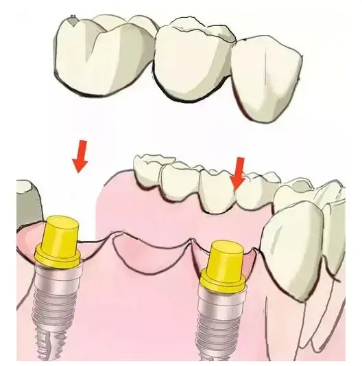 到底什么是种牙——史上最简单明了的种植牙说明来啦