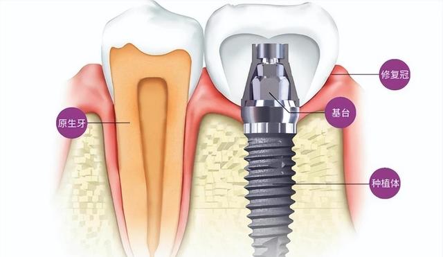 “暴利”的种植牙：成本几百售价上万？如今纳入医保，或降价90%!