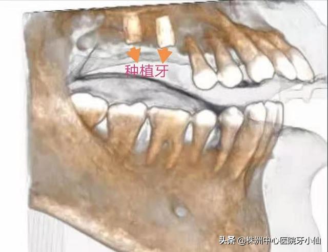 看个牙还需要拍CT？是真的有用，还是多此一举？#清风计划#