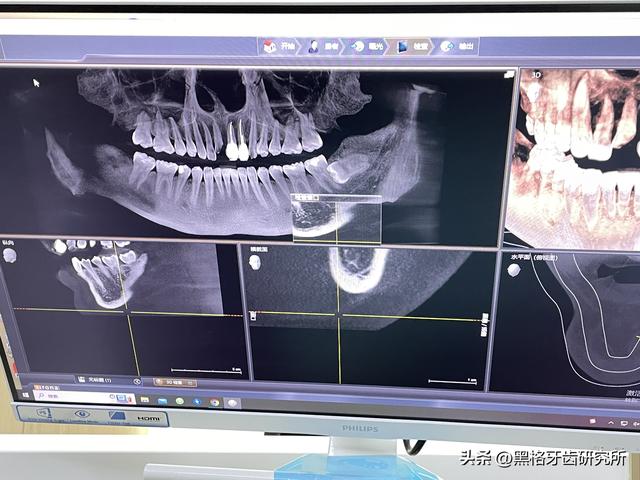 种植牙全流程要多久？当天种牙当天吃饭是真的吗？亲身经历！