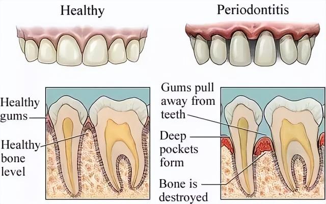 一种会让牙齿掉光的病，很多人年轻时不重视