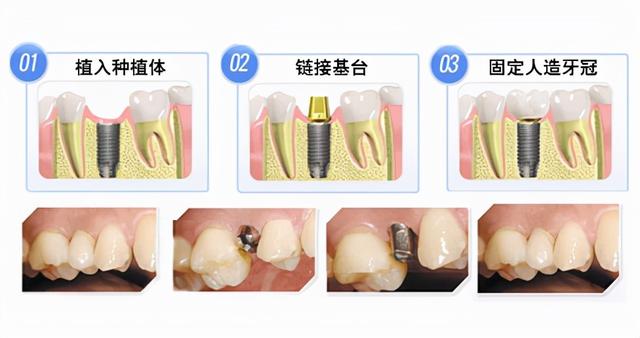 种植牙真的那么好吗？老牙医告诉你，可能需要承担这3个风险