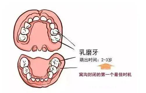 这几个年龄段做窝沟封闭最有效，快看看你家娃错过了没？