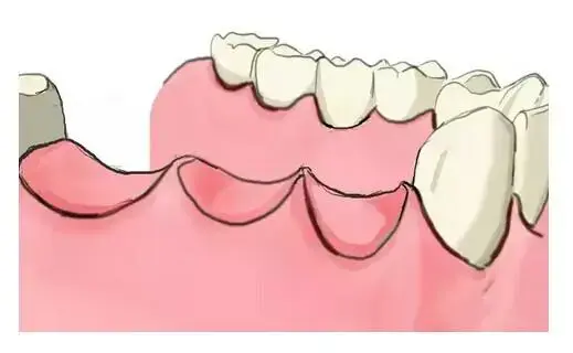 到底什么是种牙——史上最简单明了的种植牙说明来啦