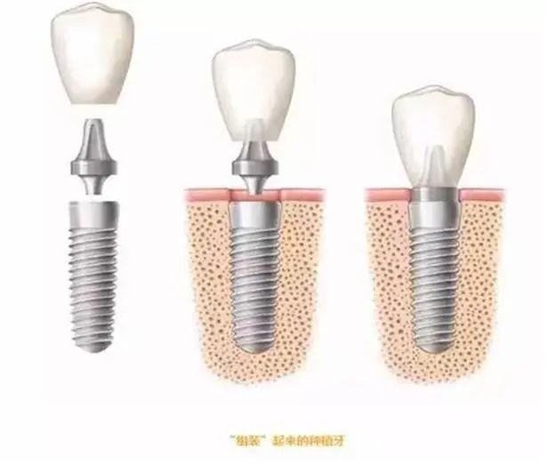 淘钉钉-这届年轻人的牙齿也不行了？螺丝植牙了解一下