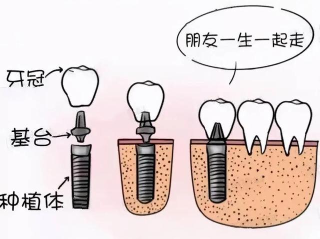 种牙如买房。我去年花49800种了5颗牙，历时7个月，现在降价了。