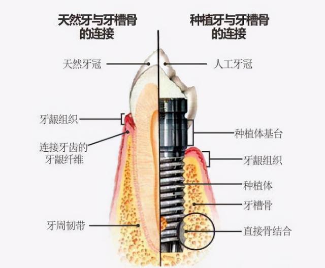 想做种植牙，但医生说我牙槽骨很薄，为什么？医生：作出来的