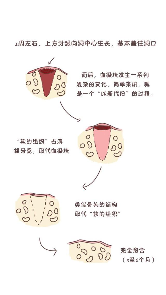 拔牙后多久才能种牙？“白跑一趟”或是“错失良机”是啥原因