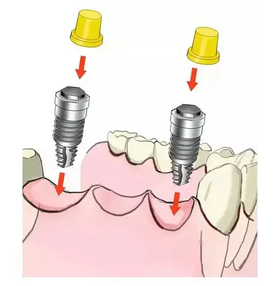 到底什么是种牙——史上最简单明了的种植牙说明来啦
