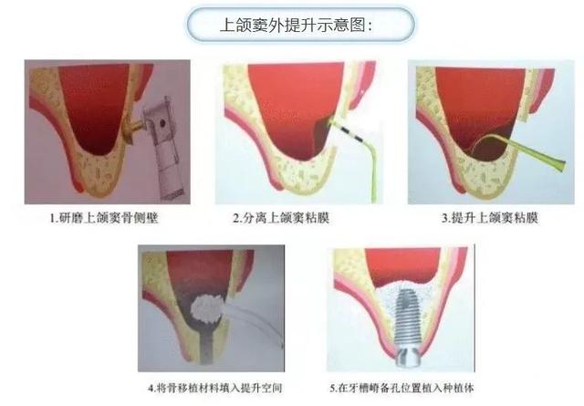 骨量不足比较常用的植骨方式是什么？对，没错就是它