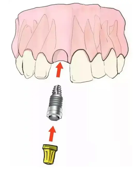 到底什么是种牙——史上最简单明了的种植牙说明来啦