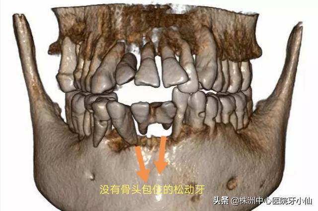 看个牙还需要拍CT？是真的有用，还是多此一举？#清风计划#