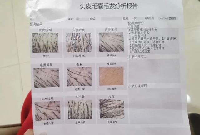 记者一线探访植发机构：其实很多脱发根本不用植