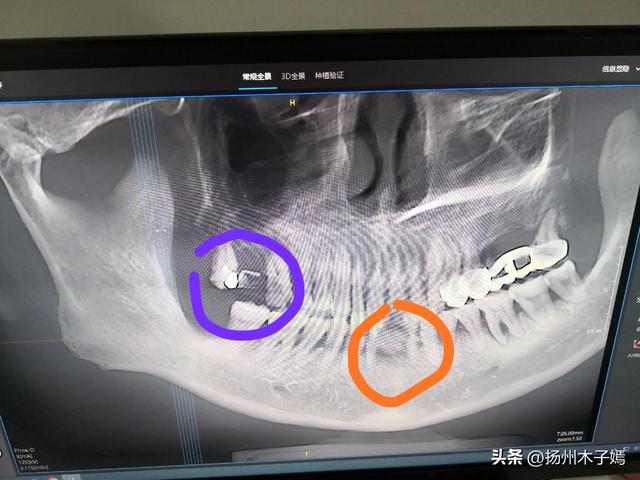 陪爸爸在仪征看牙——种植牙