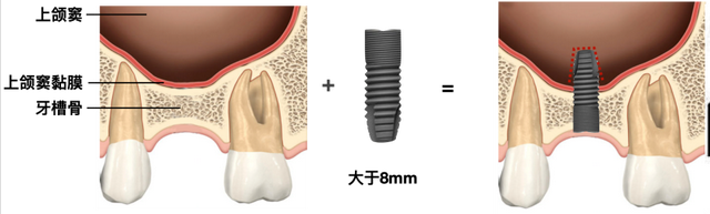 什么是上颌窦内提升？为什么要做上颌窦提升？