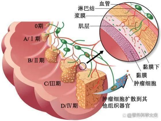 结肠癌有哪些转移