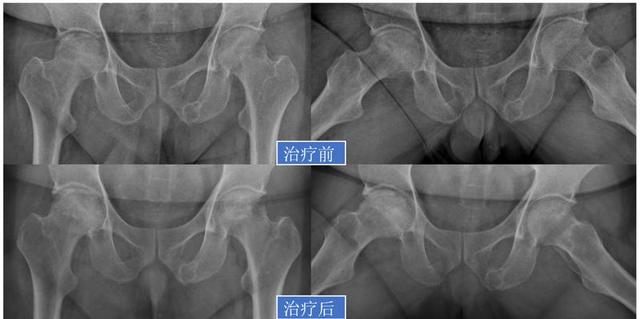 「视频」股骨头坏死：保髋or换髋？看这篇就够了