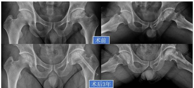 「视频」股骨头坏死：保髋or换髋？看这篇就够了