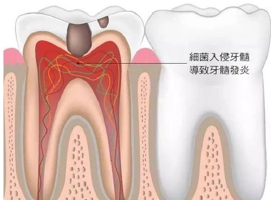 根管治疗不就是“杀神经”吗？有什么不同？