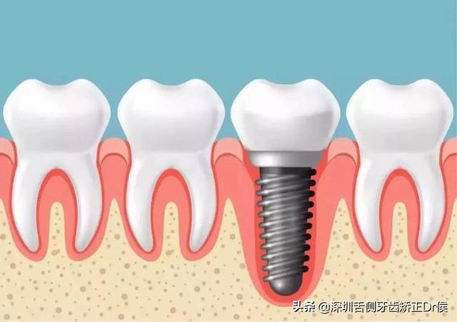 矫正也可以解决缺牙