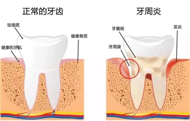 把牙“等掉”就能种？医生：还是得先治疗牙周炎