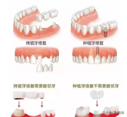 烤瓷牙与种植牙哪个好？