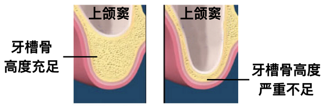 什么是上颌窦外提升？上颌窦外提升与上颌窦内提升有什么区别？