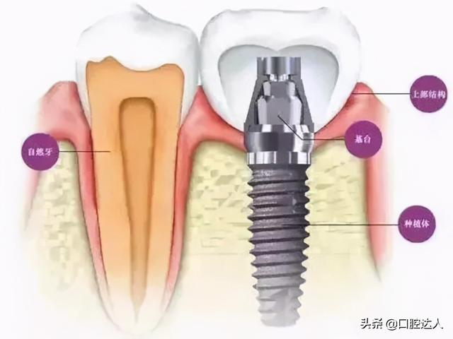 种植牙流程是什么样的呢？