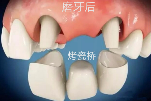 种植牙和烤瓷牙，其实并无差别？专家提醒：并非种植牙不可