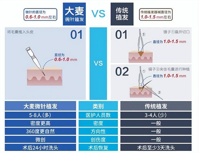 实现“发型自由”难吗？大麦微针植发帮你快速GET