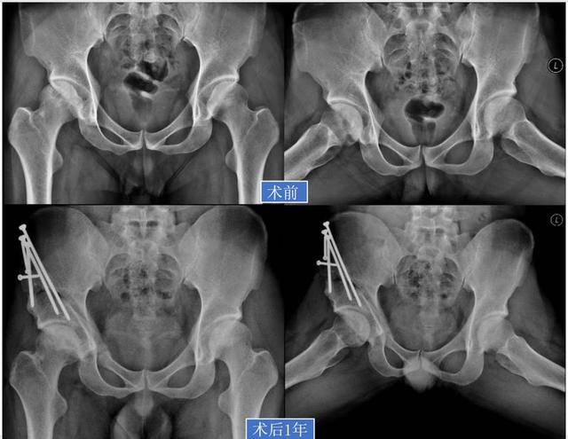 「视频」股骨头坏死：保髋or换髋？看这篇就够了