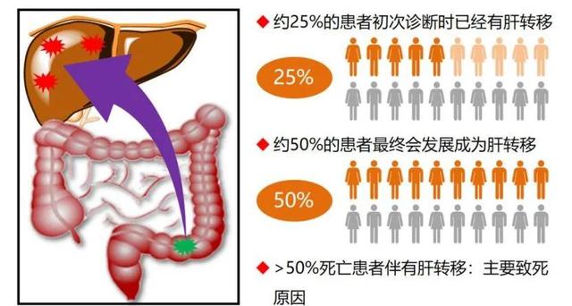 结肠癌有哪些转移