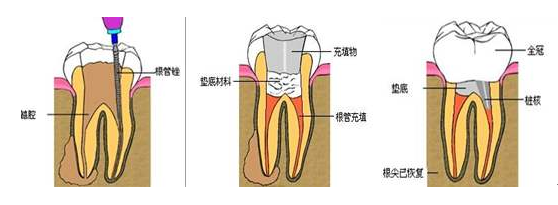 根管治疗不就是“杀神经”吗？有什么不同？