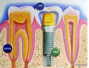 烤瓷牙与种植牙哪个好？